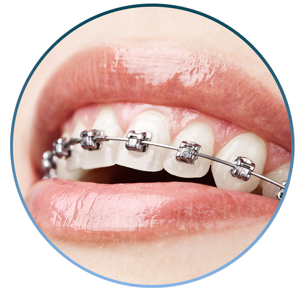 Appareil dentaire pour une orthodontie réussie
