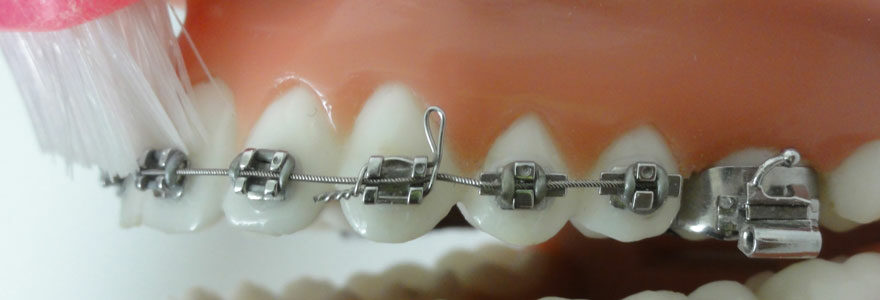 appareil dentaire