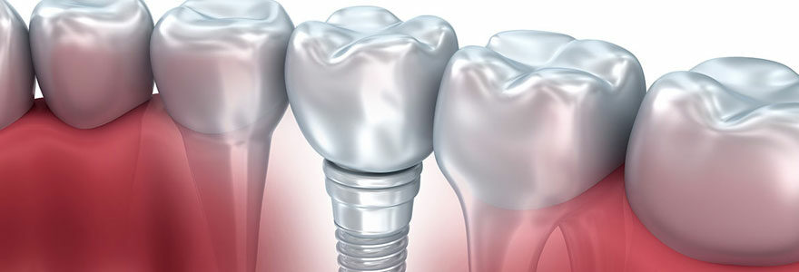L’implant dentaire