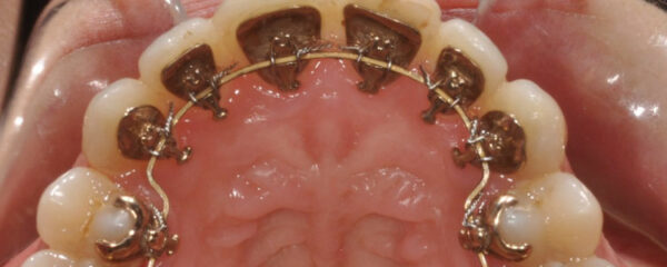 appareil dentaire lingual