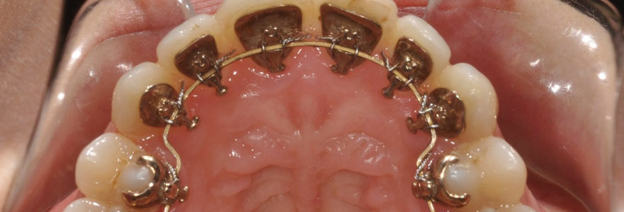 appareil dentaire lingual
