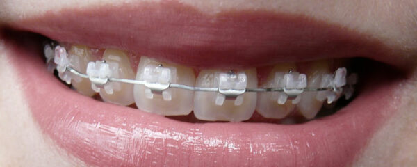 un traitement orthodontique