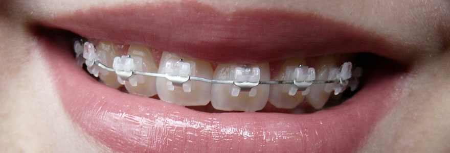 un traitement orthodontique
