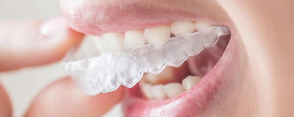 L'orthodontie invisible